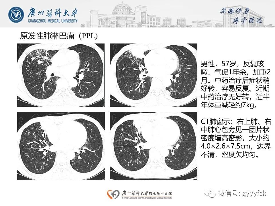 影像PPT - 【PPT】机化性肺炎-26