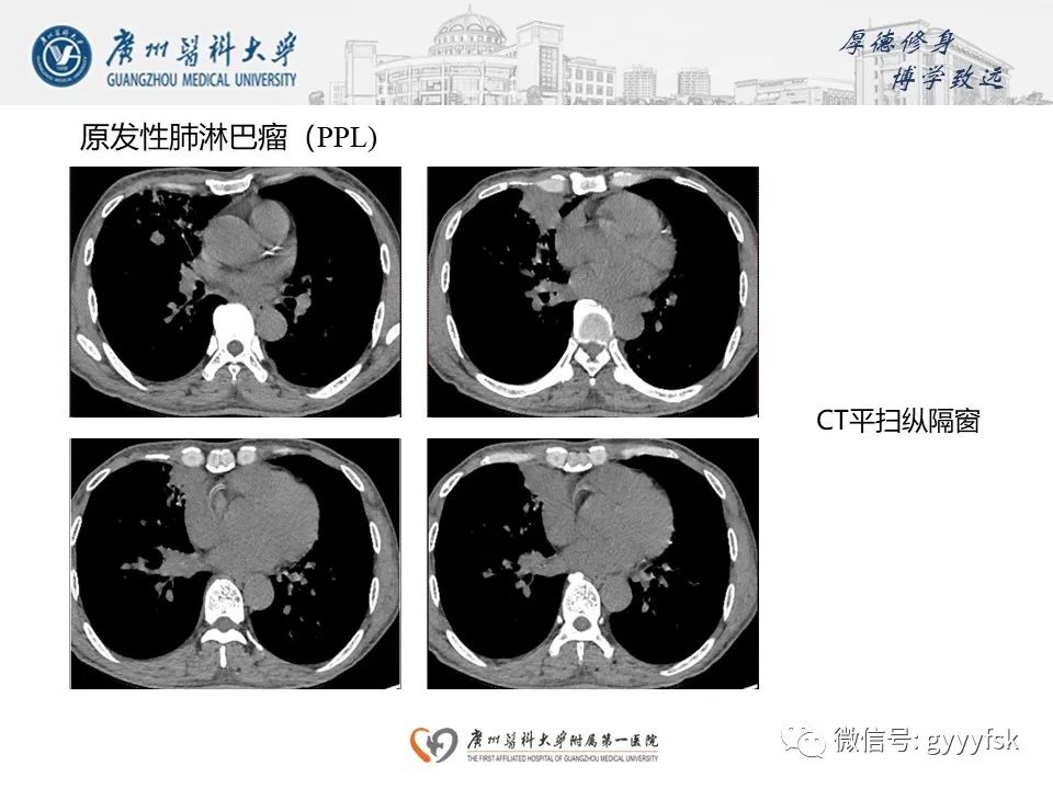 影像PPT - 【PPT】机化性肺炎-27