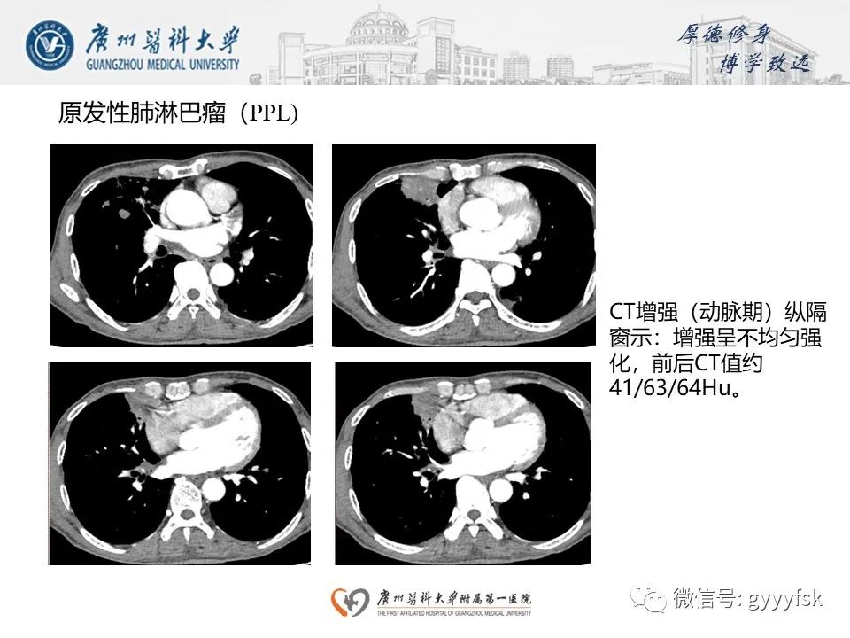 影像PPT - 【PPT】机化性肺炎-28