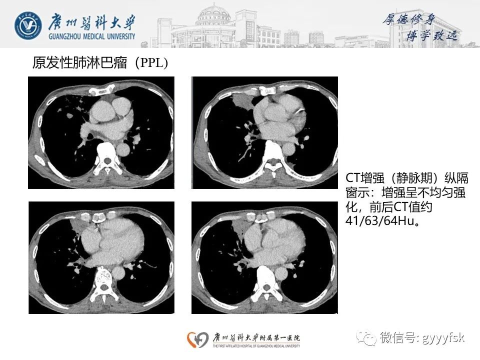 影像PPT - 【PPT】机化性肺炎-29