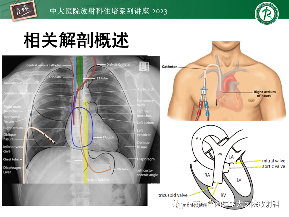 影像PPT - 【PPT】体部常见置管影像解读-5