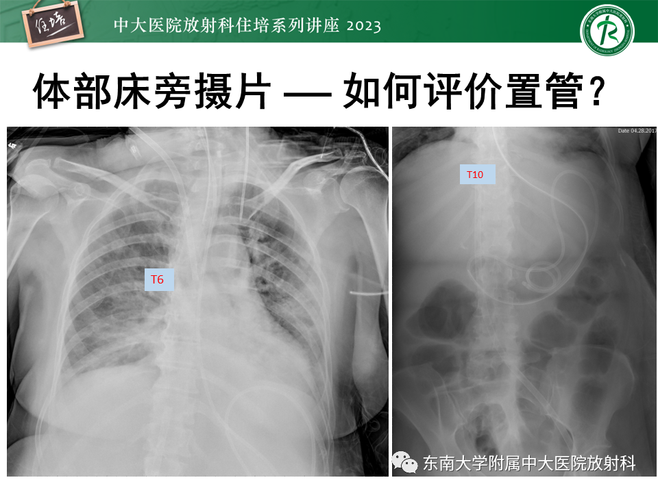 影像PPT - 【PPT】体部常见置管影像解读-2