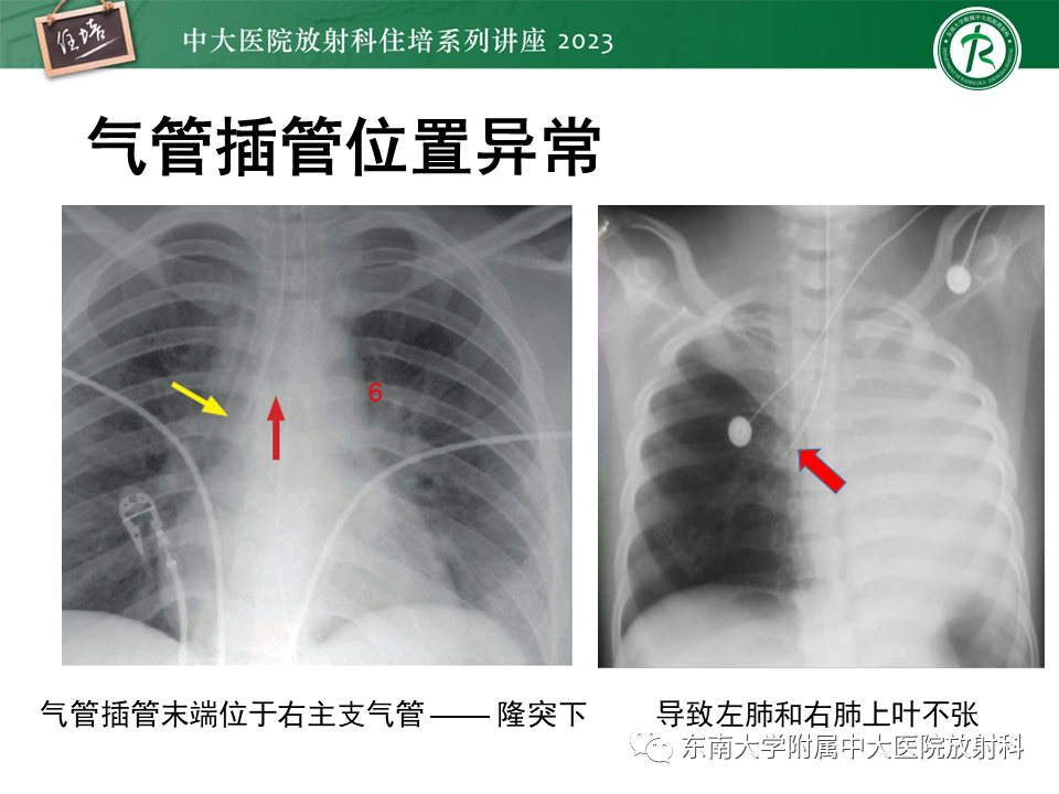 影像PPT - 【PPT】体部常见置管影像解读-10