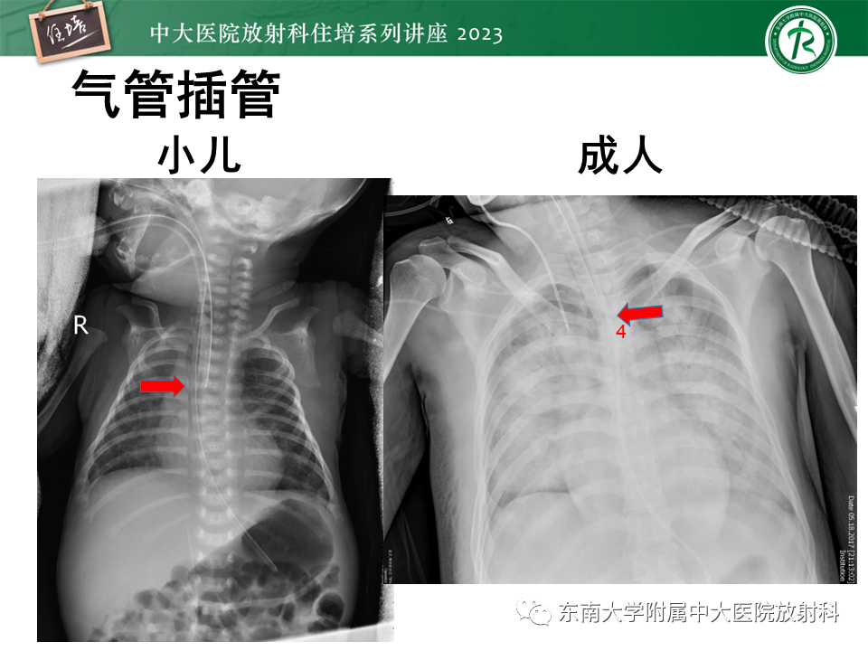 影像PPT - 【PPT】体部常见置管影像解读-9