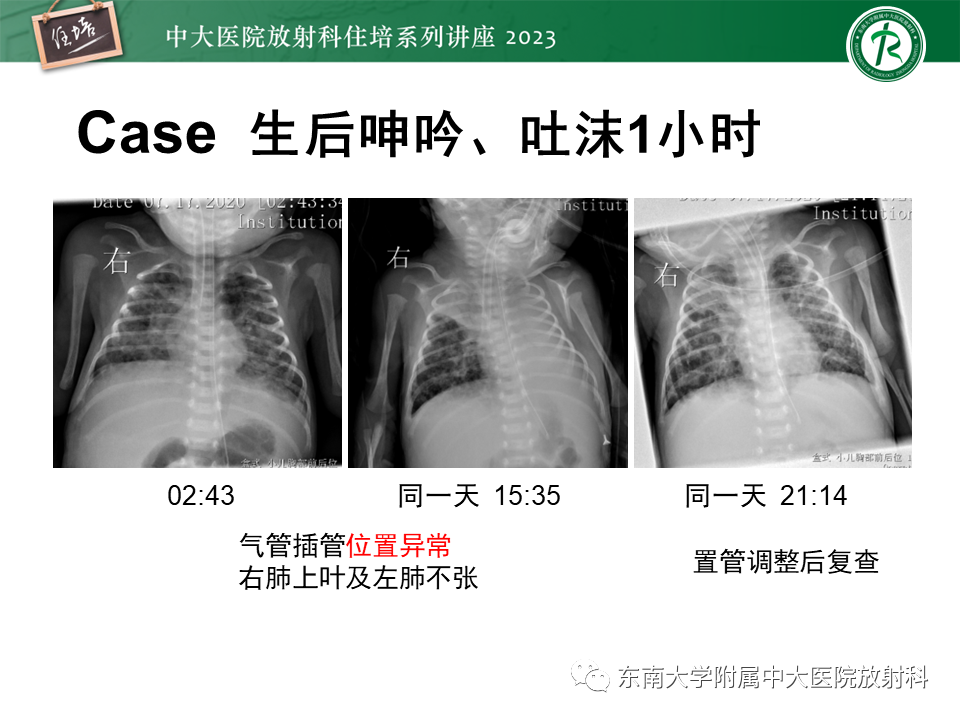 影像PPT - 【PPT】体部常见置管影像解读-11