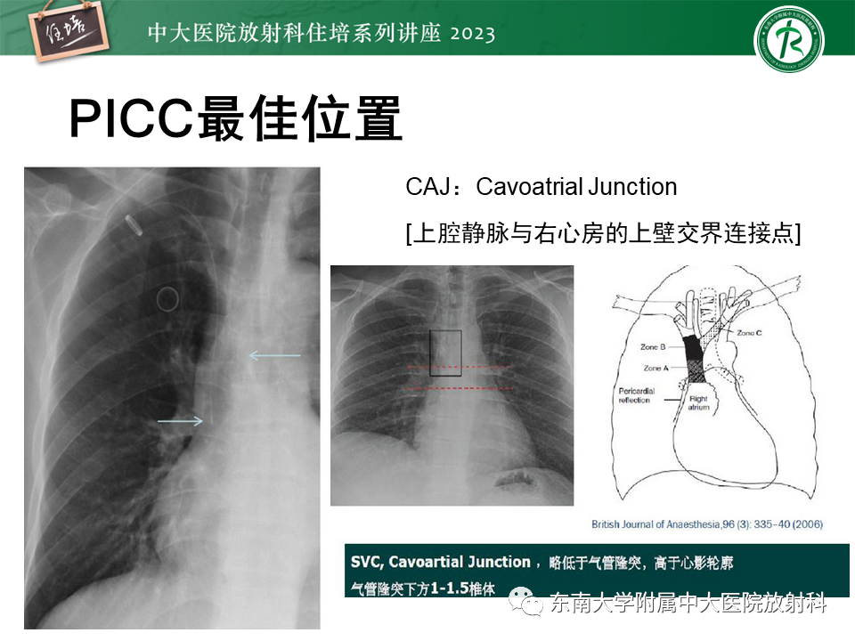 影像PPT - 【PPT】体部常见置管影像解读-15