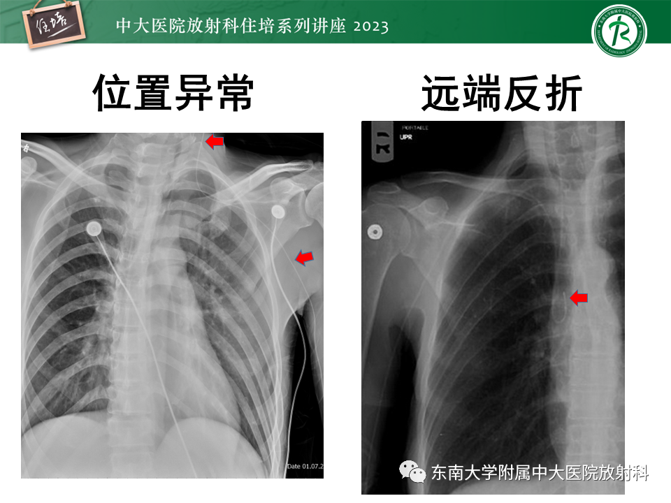 影像PPT - 【PPT】体部常见置管影像解读-16