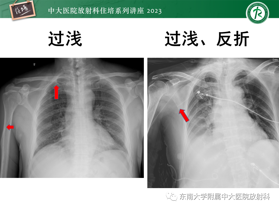 影像PPT - 【PPT】体部常见置管影像解读-17
