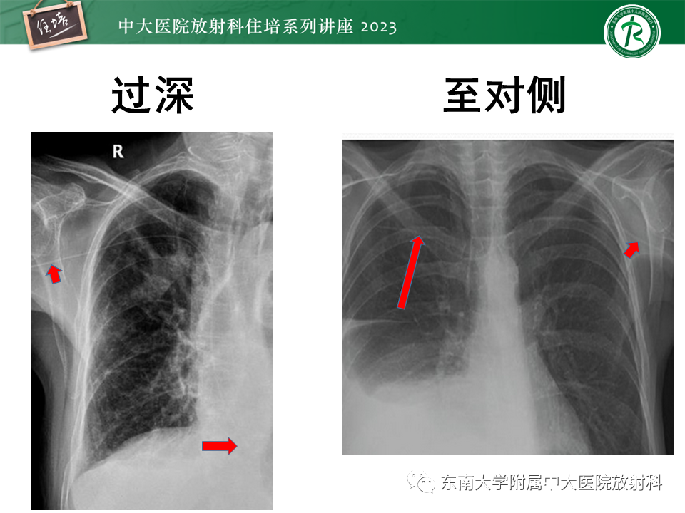 影像PPT - 【PPT】体部常见置管影像解读-18