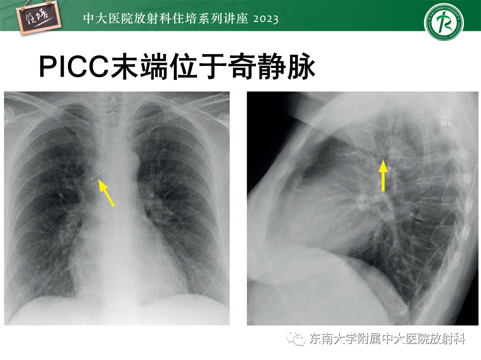 影像PPT - 【PPT】体部常见置管影像解读-19