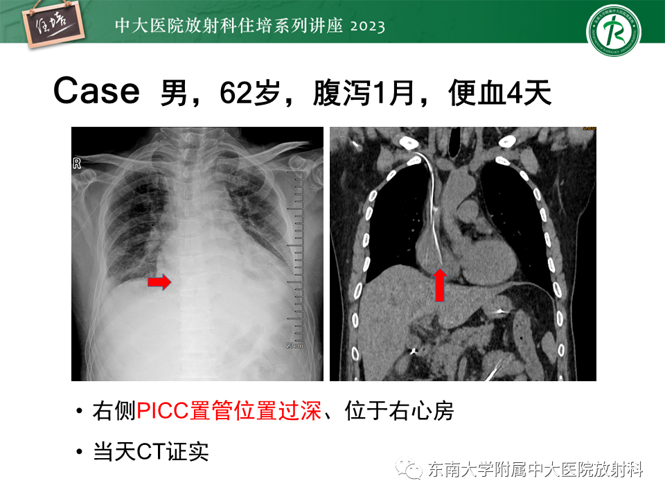 影像PPT - 【PPT】体部常见置管影像解读-20