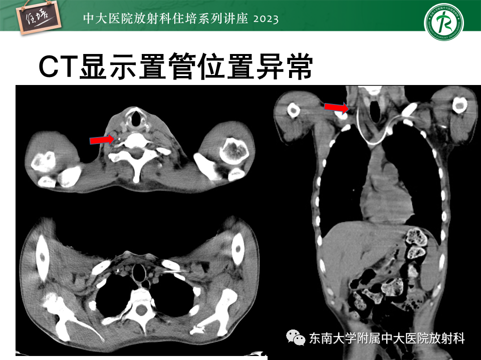 影像PPT - 【PPT】体部常见置管影像解读-21