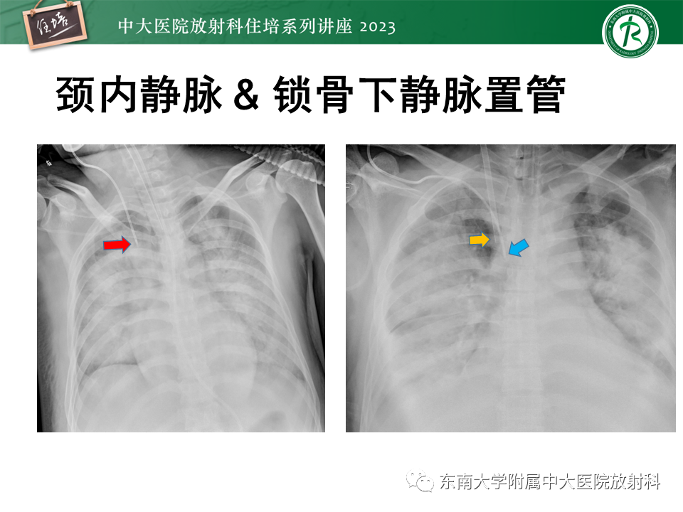 影像PPT - 【PPT】体部常见置管影像解读-25