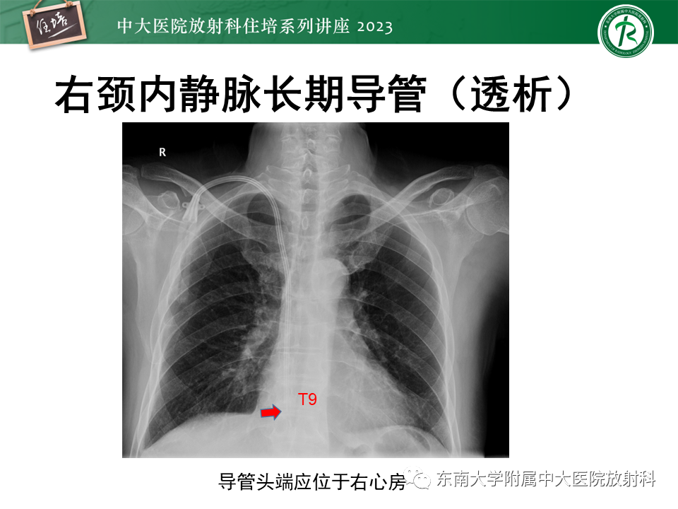 影像PPT - 【PPT】体部常见置管影像解读-26