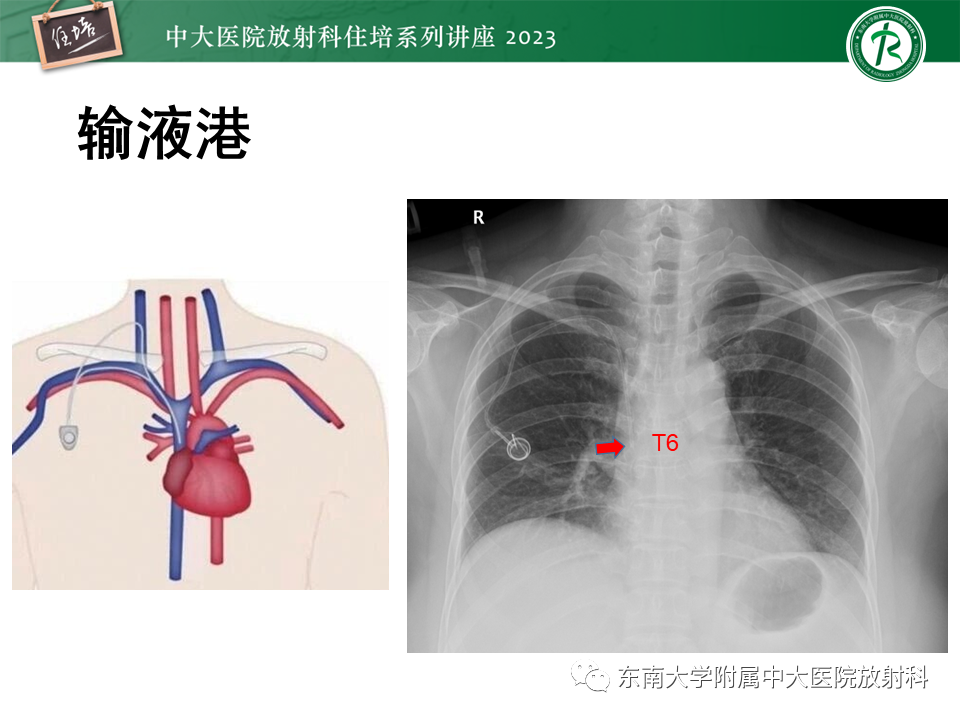影像PPT - 【PPT】体部常见置管影像解读-27