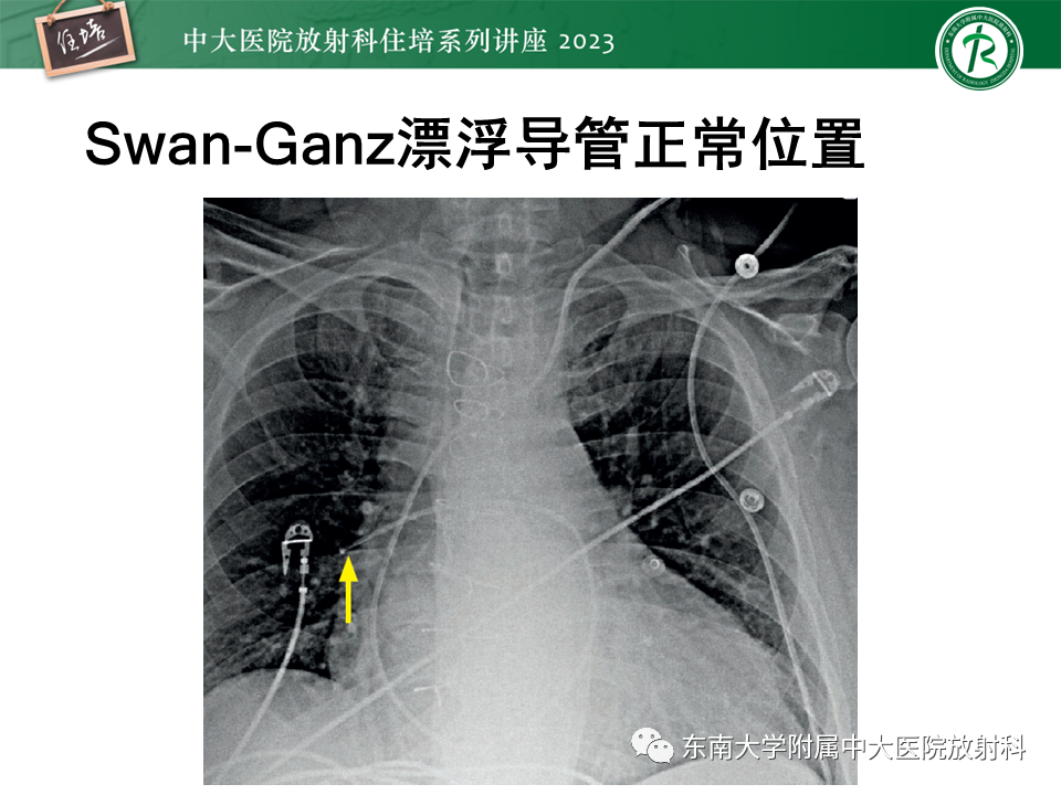 影像PPT - 【PPT】体部常见置管影像解读-29