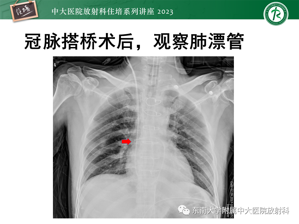 影像PPT - 【PPT】体部常见置管影像解读-30