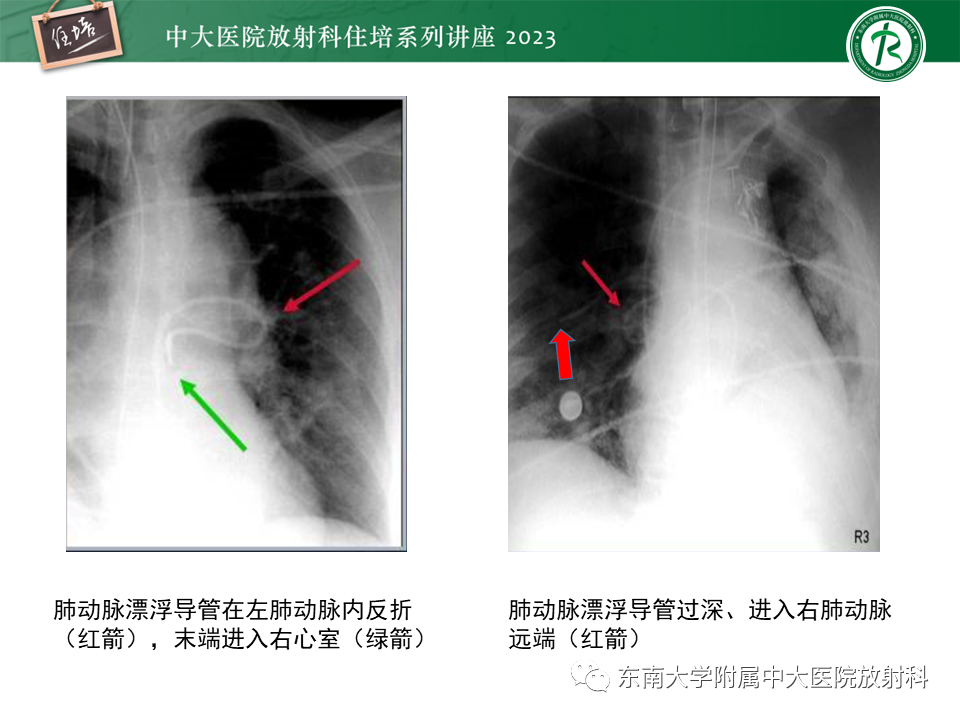 影像PPT - 【PPT】体部常见置管影像解读-31
