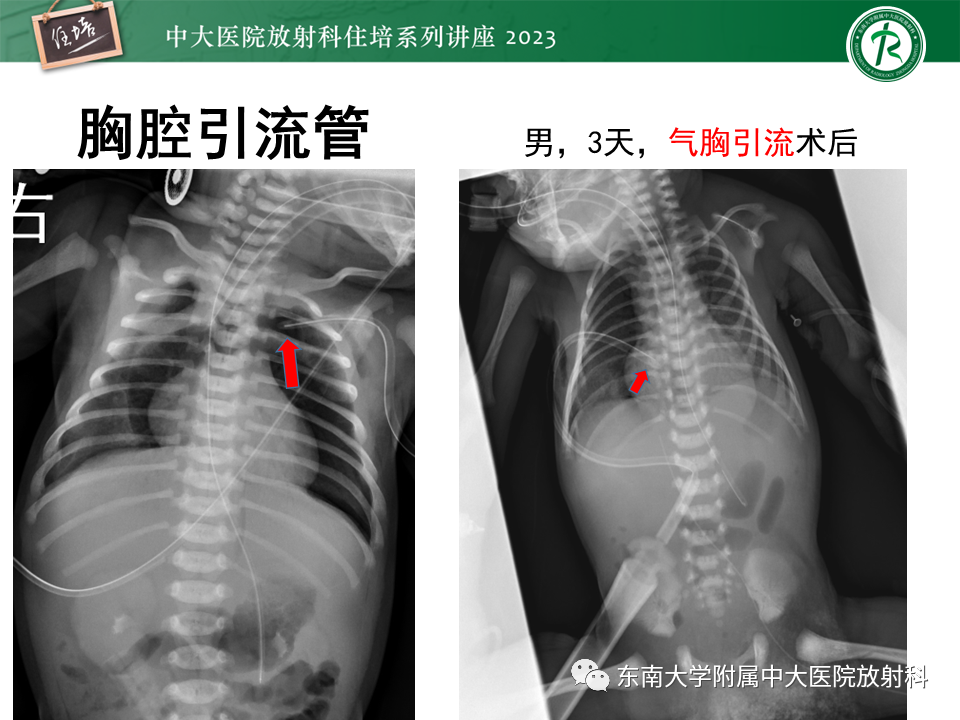 影像PPT - 【PPT】体部常见置管影像解读-33