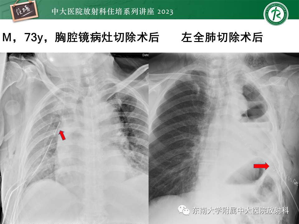 影像PPT - 【PPT】体部常见置管影像解读-34