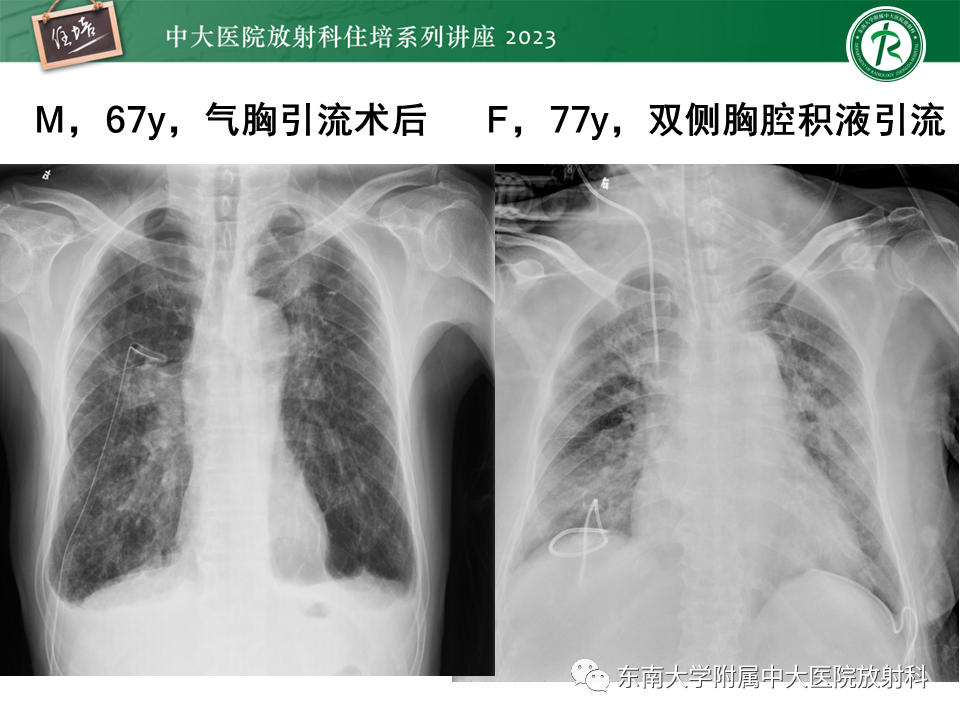 影像PPT - 【PPT】体部常见置管影像解读-35