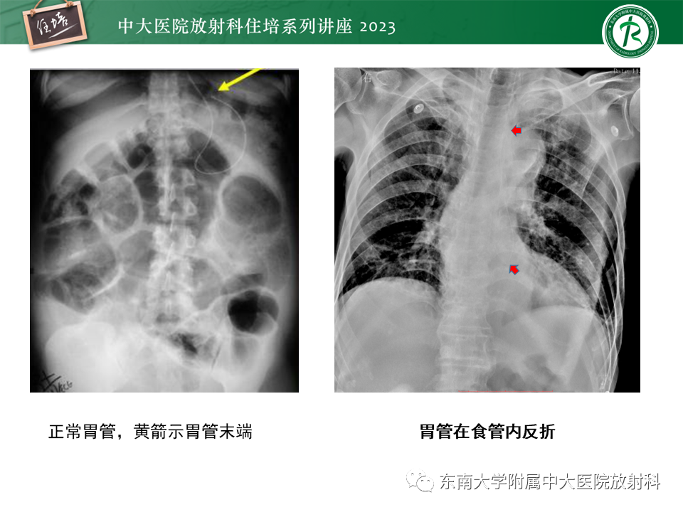 影像PPT - 【PPT】体部常见置管影像解读-37