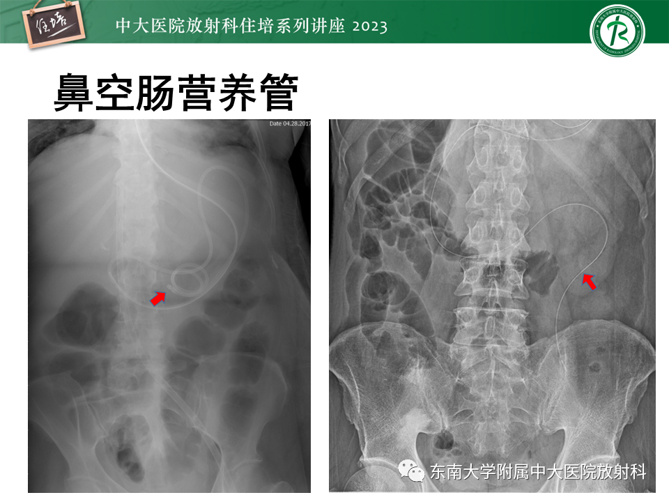 影像PPT - 【PPT】体部常见置管影像解读-38