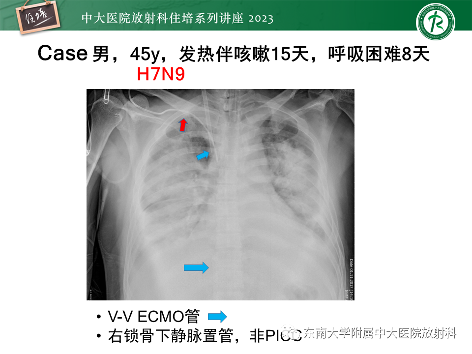 影像PPT - 【PPT】体部常见置管影像解读-40