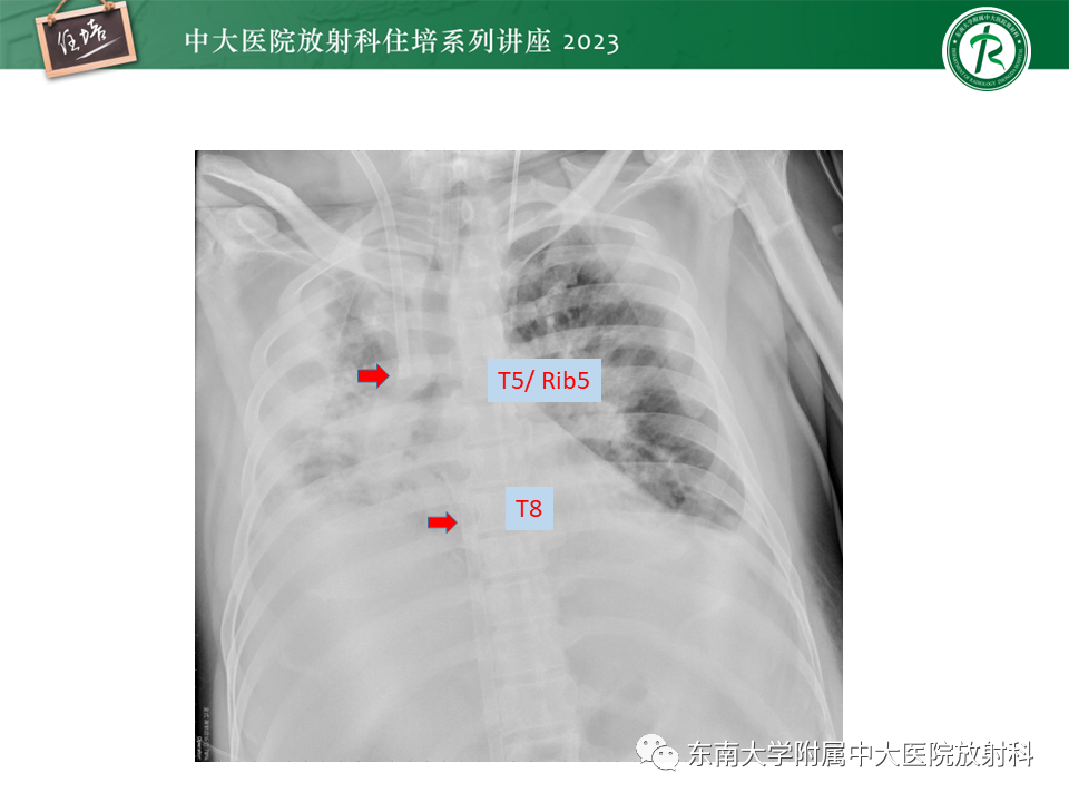 影像PPT - 【PPT】体部常见置管影像解读-41