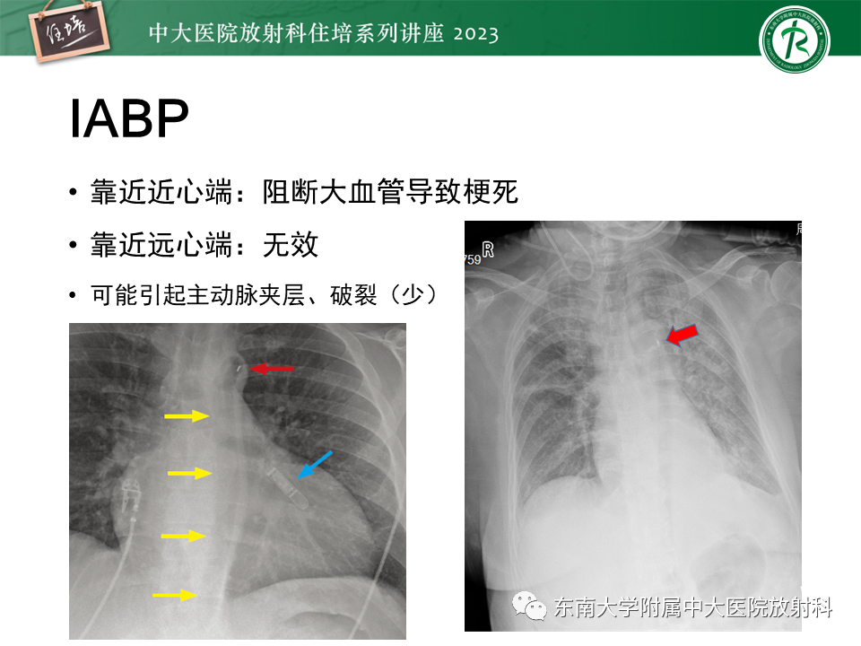 影像PPT - 【PPT】体部常见置管影像解读-43
