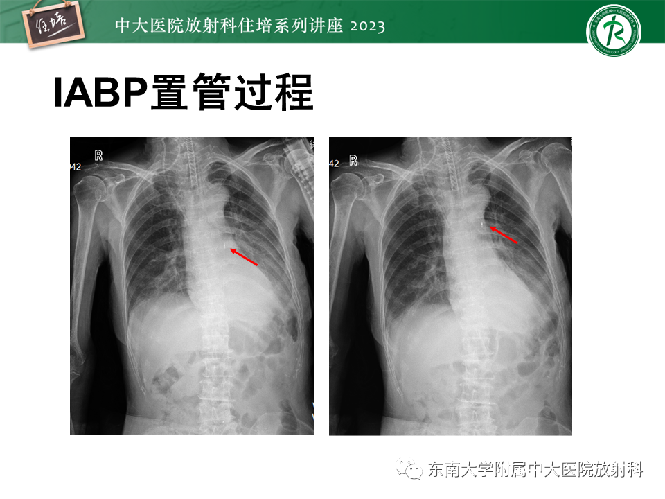 影像PPT - 【PPT】体部常见置管影像解读-44