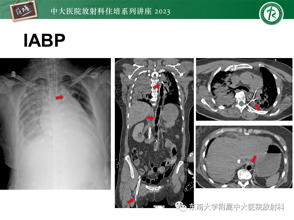 影像PPT - 【PPT】体部常见置管影像解读-45