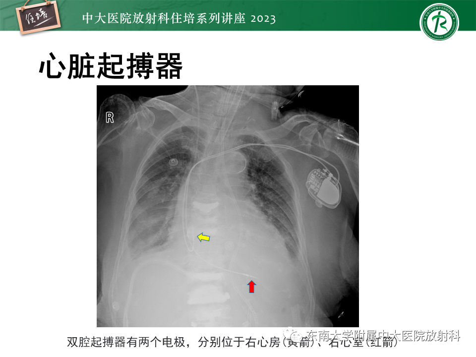 影像PPT - 【PPT】体部常见置管影像解读-46