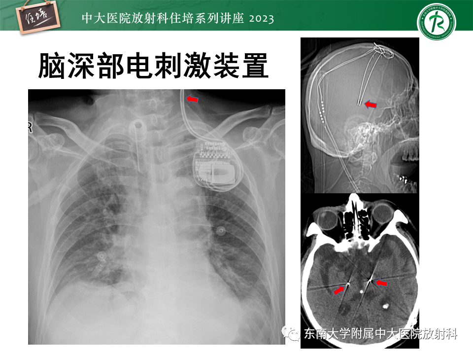 影像PPT - 【PPT】体部常见置管影像解读-47