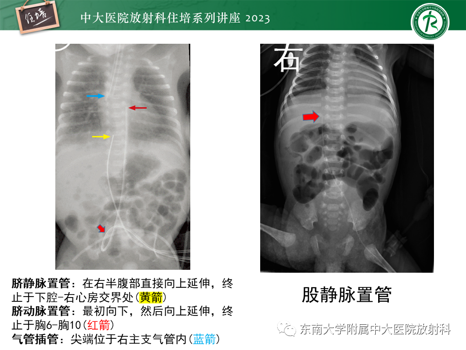 影像PPT - 【PPT】体部常见置管影像解读-52