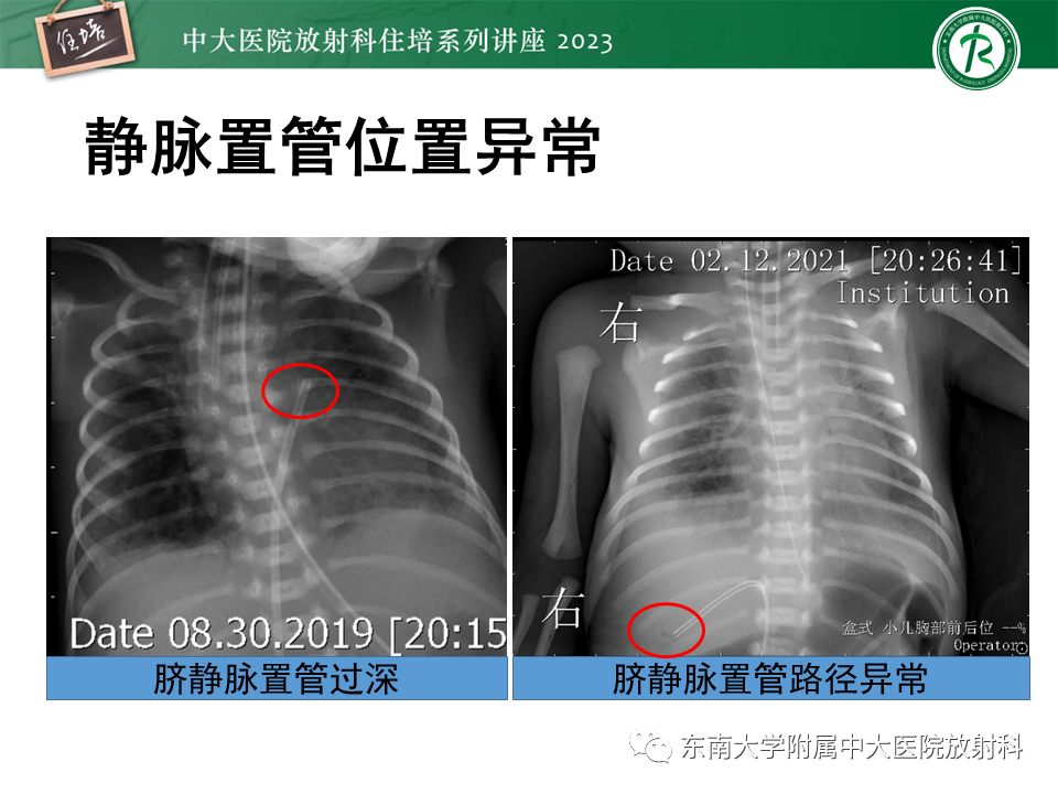影像PPT - 【PPT】体部常见置管影像解读-54