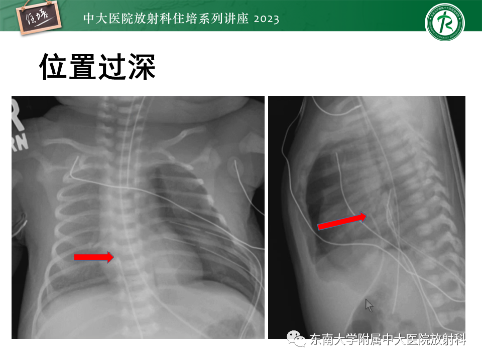 影像PPT - 【PPT】体部常见置管影像解读-55