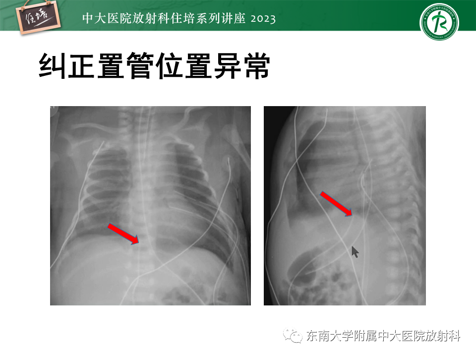 影像PPT - 【PPT】体部常见置管影像解读-56
