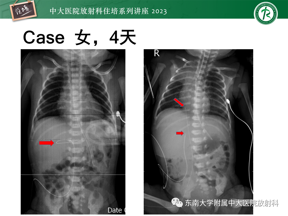 影像PPT - 【PPT】体部常见置管影像解读-57