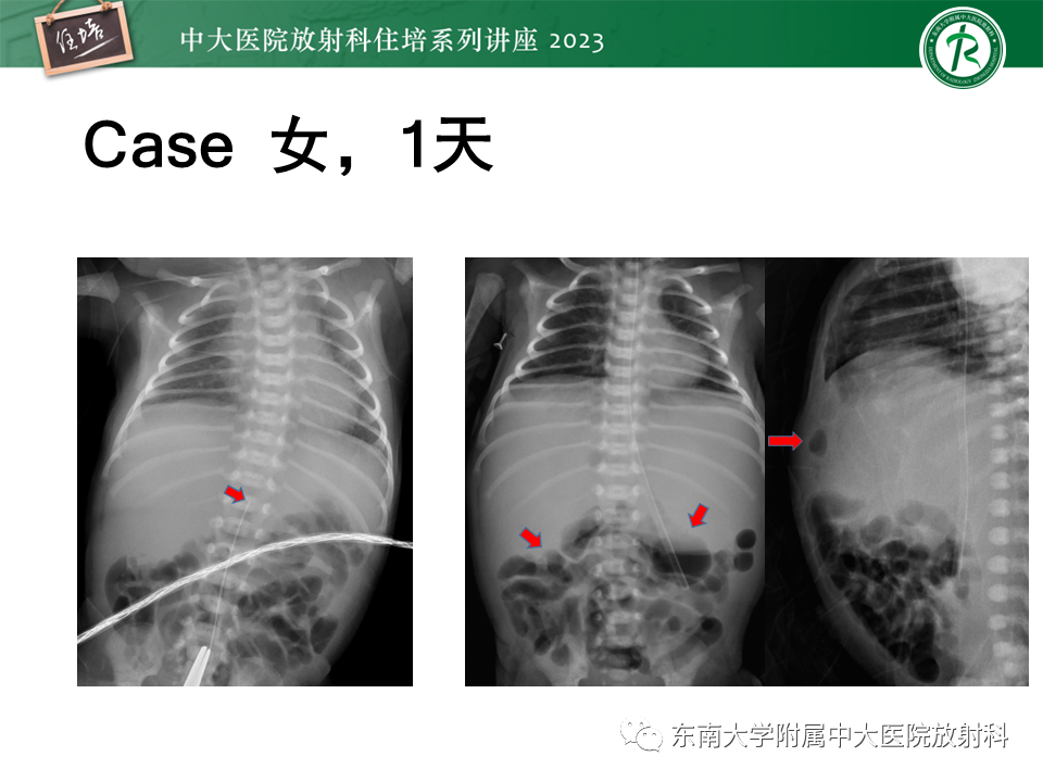 影像PPT - 【PPT】体部常见置管影像解读-58