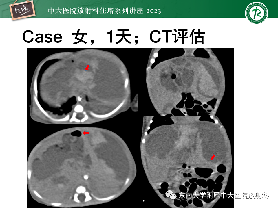影像PPT - 【PPT】体部常见置管影像解读-59