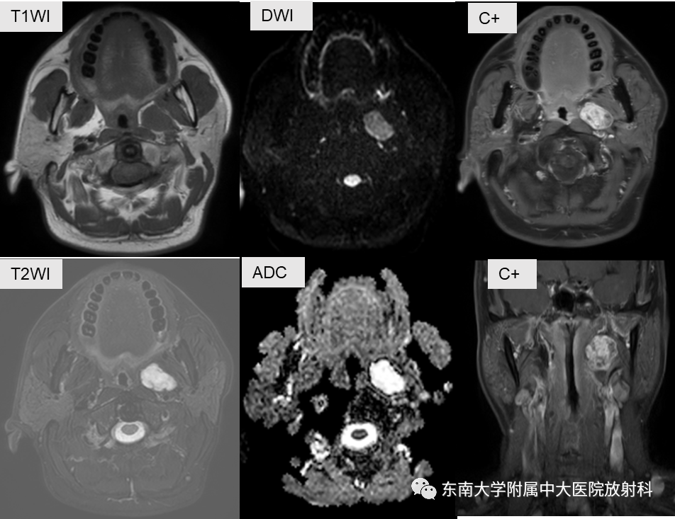 影像PPT - 【PPT】多形性腺瘤-2