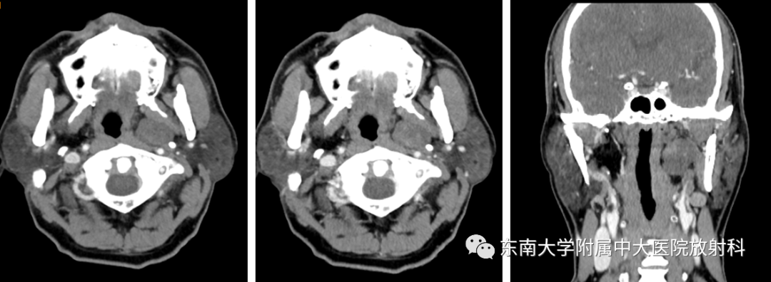 影像PPT - 【PPT】多形性腺瘤-1