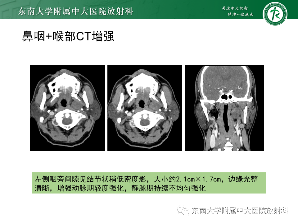 影像PPT - 【PPT】多形性腺瘤-3