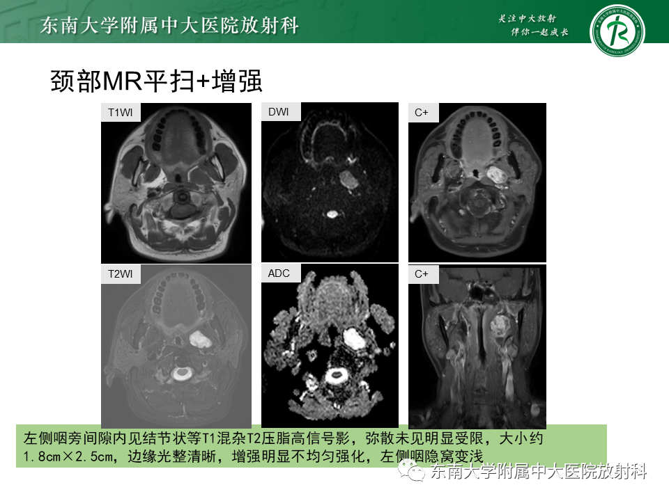影像PPT - 【PPT】多形性腺瘤-4