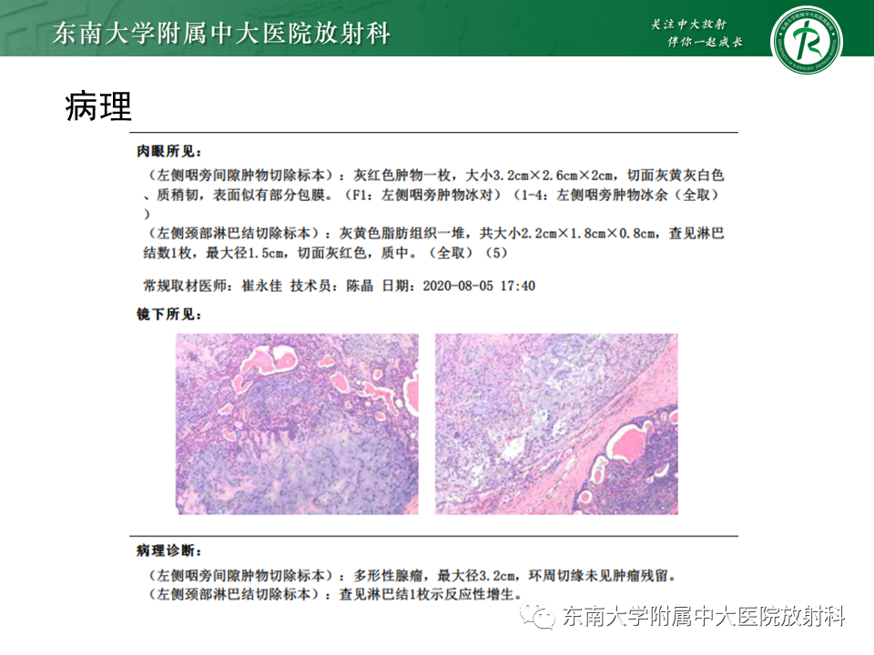 影像PPT - 【PPT】多形性腺瘤-5