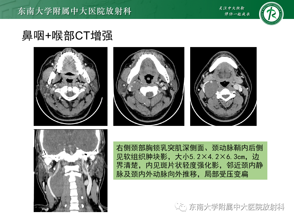 影像PPT - 【PPT】多形性腺瘤-15