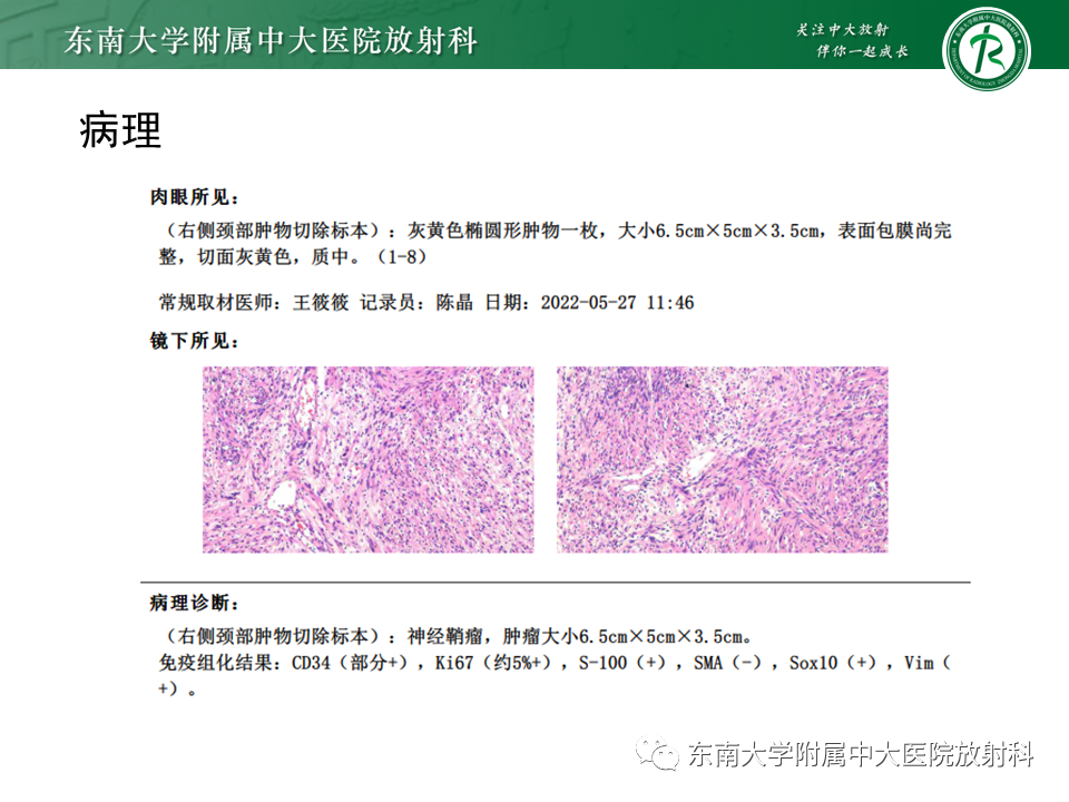 影像PPT - 【PPT】多形性腺瘤-16