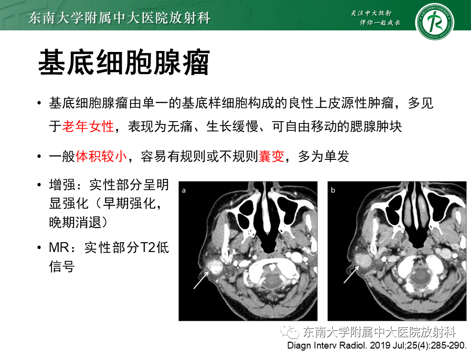 影像PPT - 【PPT】多形性腺瘤-23
