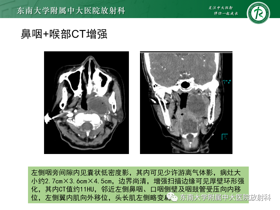 影像PPT - 【PPT】多形性腺瘤-25